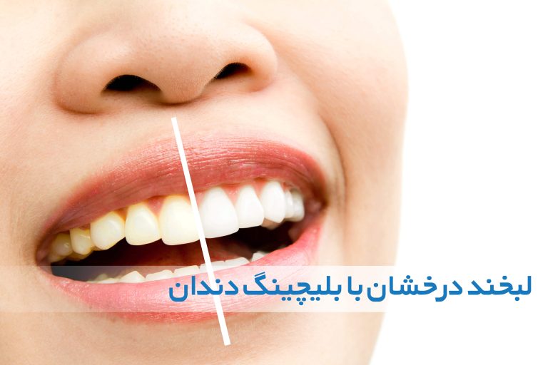 بلیچینگ دندان