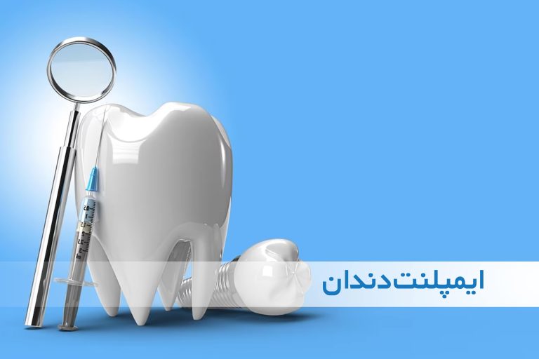 ایمپلنت