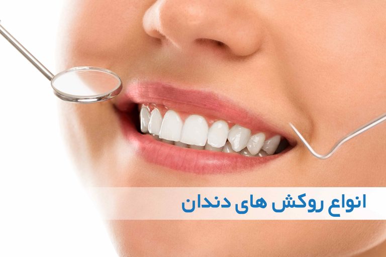 روکش دندان