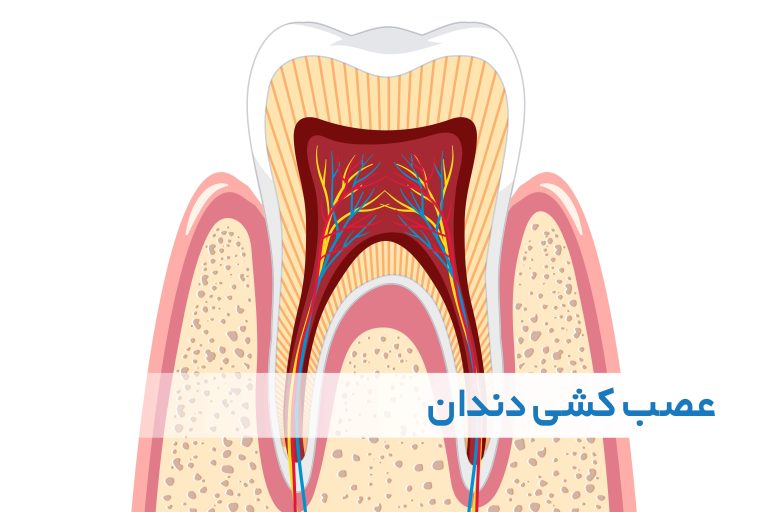 عصب کشی