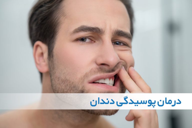 درمان پوسیدگی