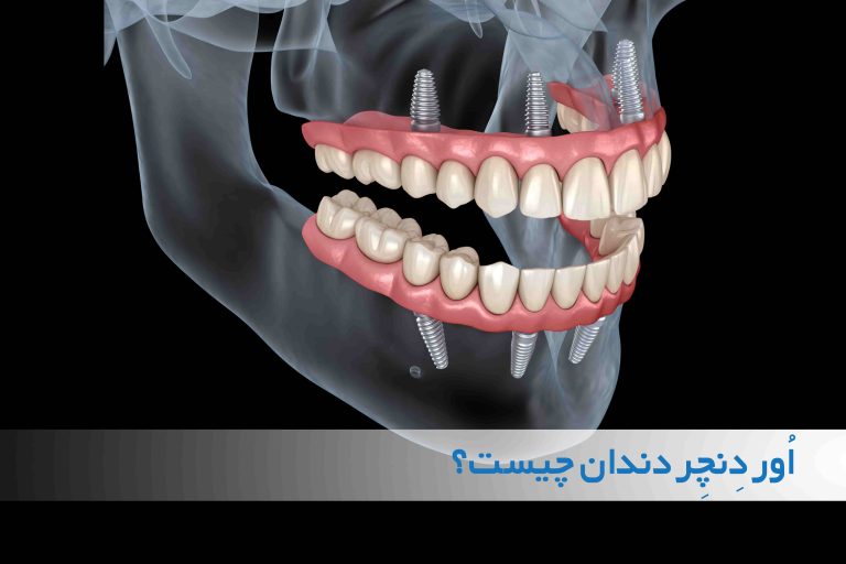 اوردنچر