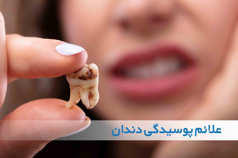 علائم پوسیدگی دندان