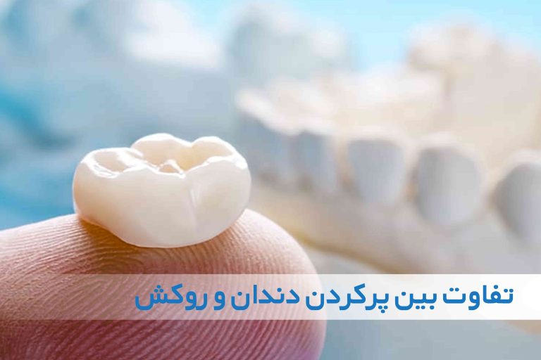 تفاوت بین پرکردن دندان و روکش دندان
