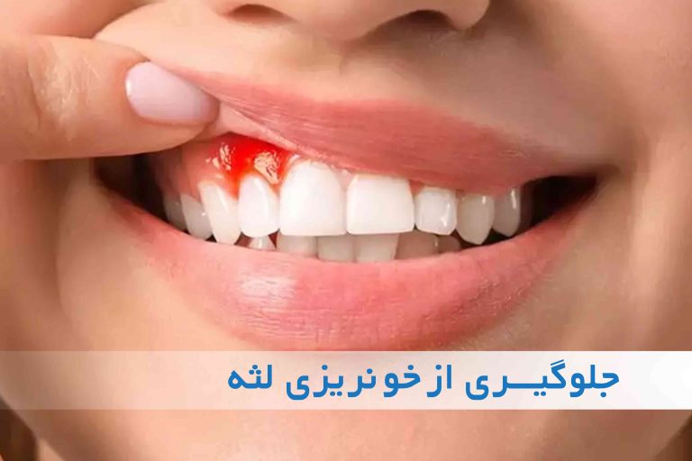 خونریزی لثه