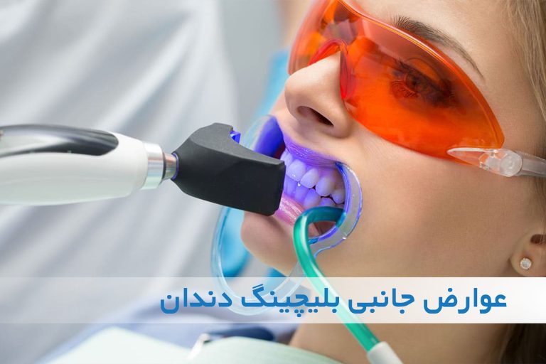 عوارض جانبی بلیچینگ دندان