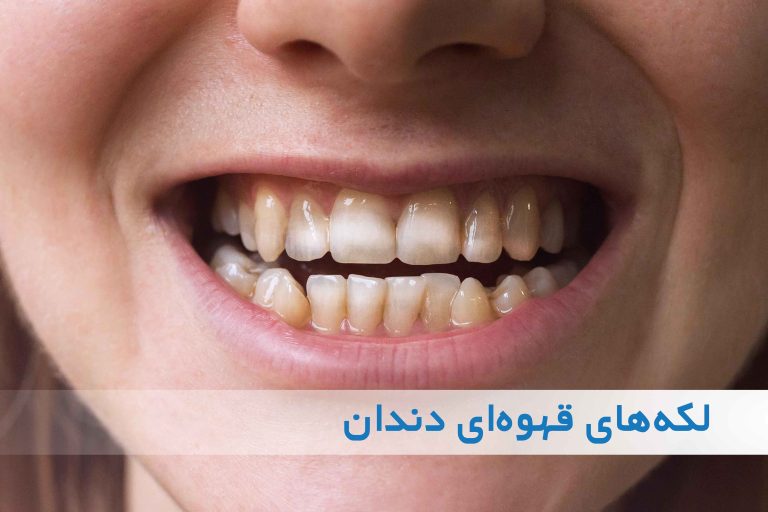 لکه‌های قهوه‌ای روی دندان‌ها