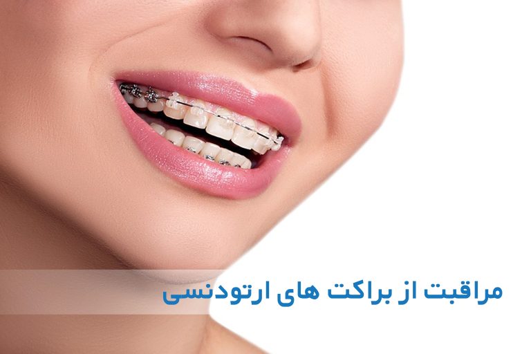چگونه باید از براکت‌های ارتودنسی مراقبت کرد؟