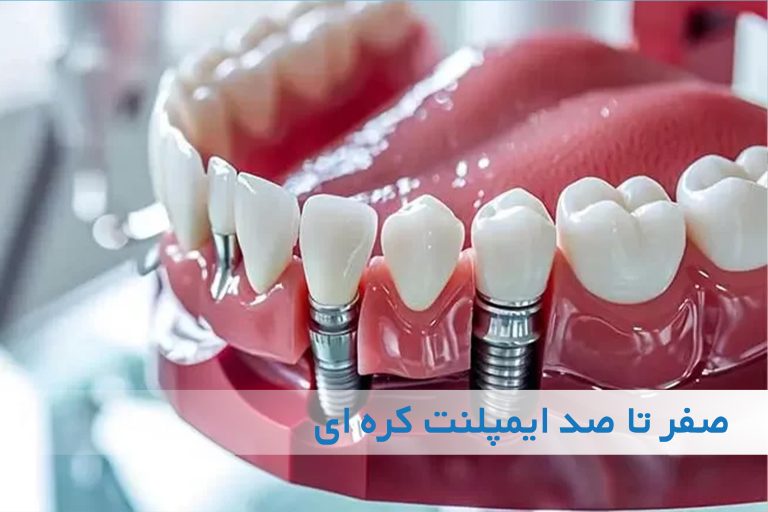 صفر تا صد ایمپلنت کره ای