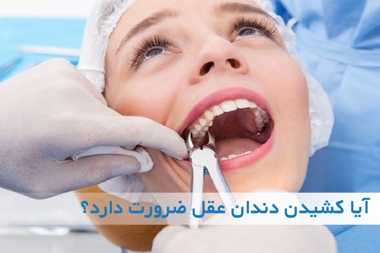 دندان عقل و ضرورت های آن