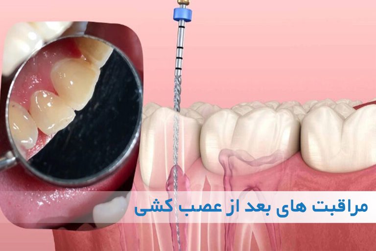 مراقبت از دندان پس از عصب‌کشی