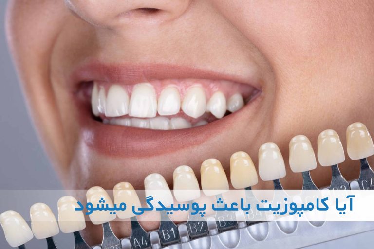 آیا کامپوزیت باعث پوسیدگی دندان می‌شود؟
