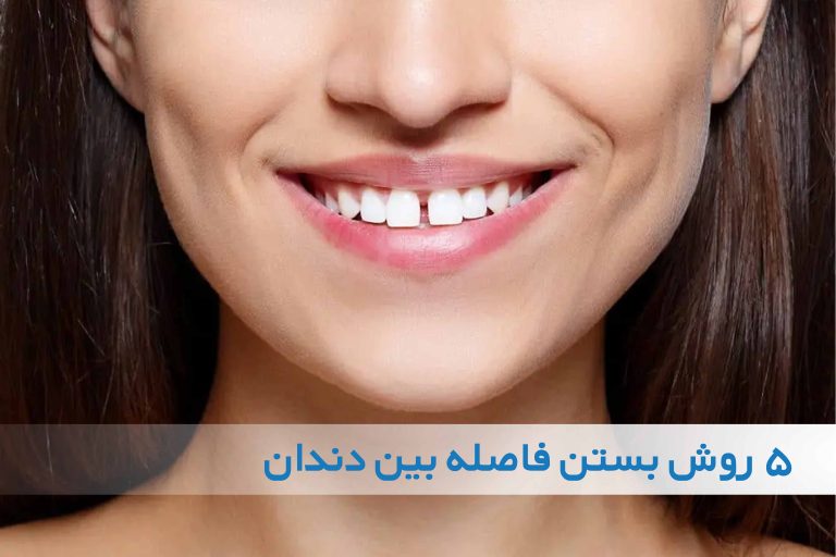 بستن فاصله بین دندان ها