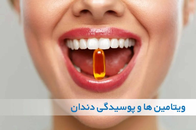 کمبود کدام ویتامین ها سبب پوسیدگی دندان می شود؟