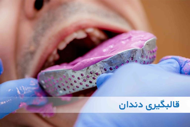 قالب گیری دندان