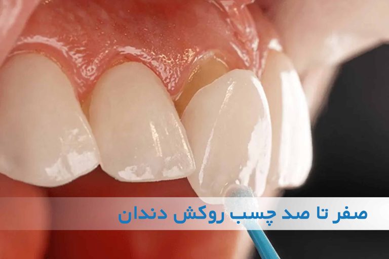 صفر تا صد چسب روکش دندان
