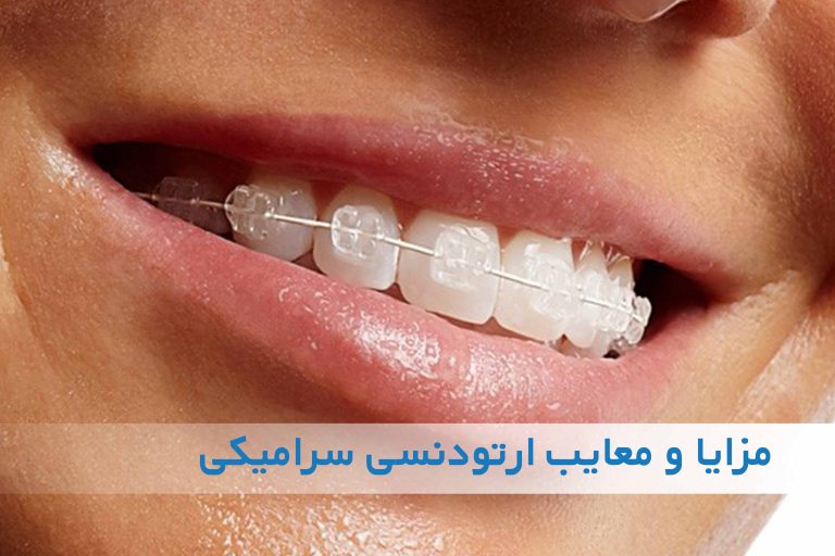 مزایا و معایب ارتودنسی سرامیکی