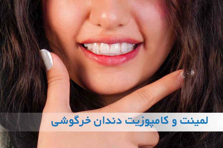 لمینت و کامپوزیت برای دندان‌های خرگوشی