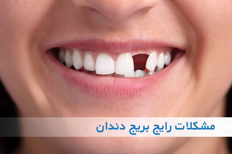بریج دندان