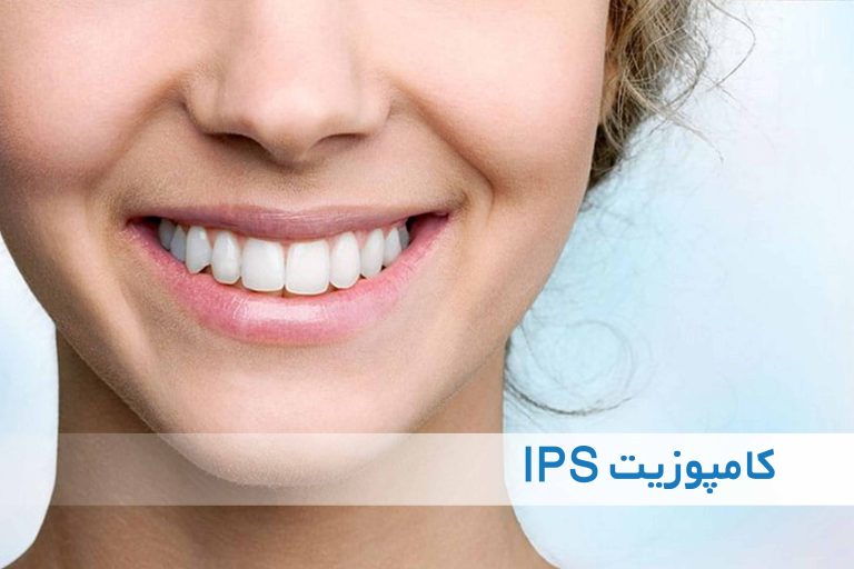 مزایا کامپوزیت ای پی اس
