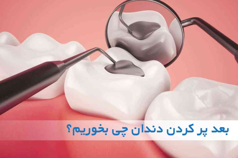 بعد پر کردن دندان چی بخوریم؟