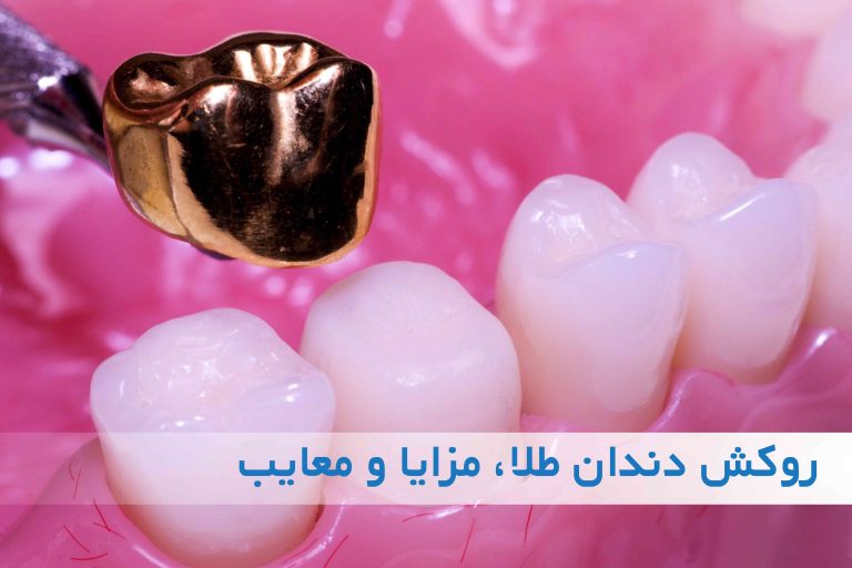 روکش دندان طلا
