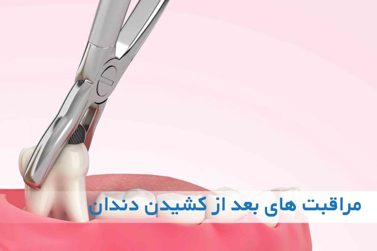 مراقبت های بعد از کشیدن دندان
