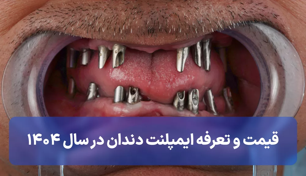 قیمت و تعرفه ایمپلنت دندان در سال ۱۴۰۴